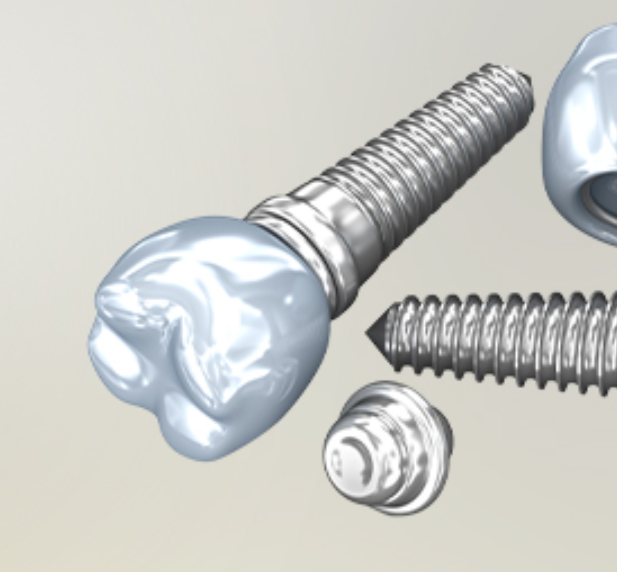 디지털 기술 도입<br>
메인 임플란트