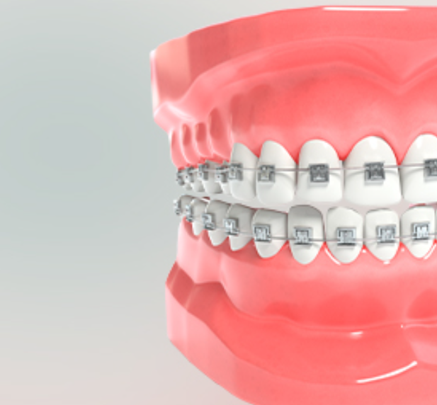 교정과 전문의 맞춤<br>
메인 치아교정